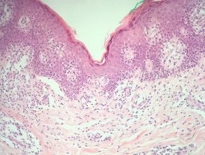 mycosis fungoides histology