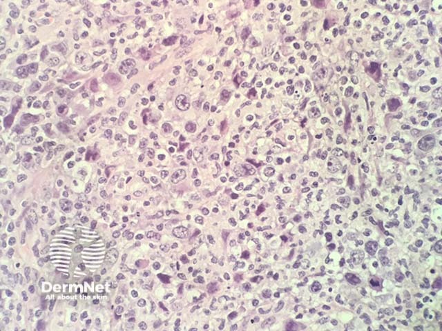 Mycosis fungoides, histology