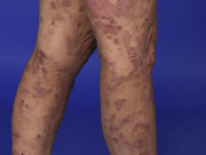 Plaque stage mycosis fungoides