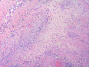 Myxofibrosarcoma pathology