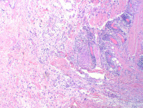 Myxofibrosarcoma pathology | DermNet NZ