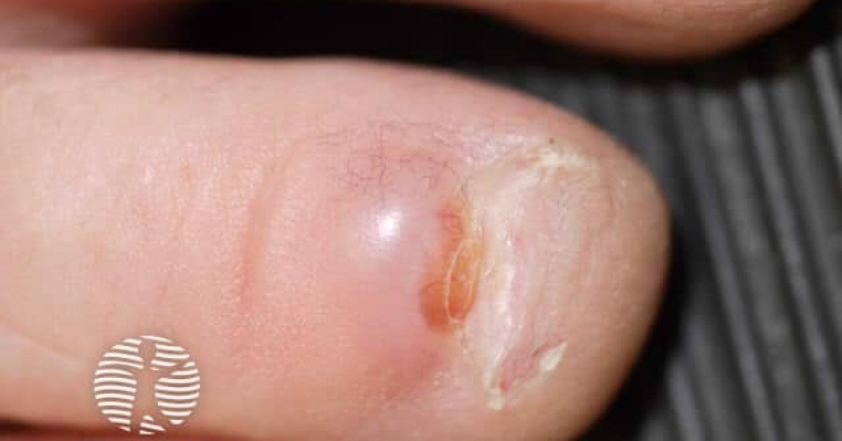 icd 10 code for digital myxoid cyst