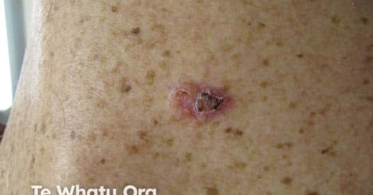 Nodular basal cell carcinoma, arm image