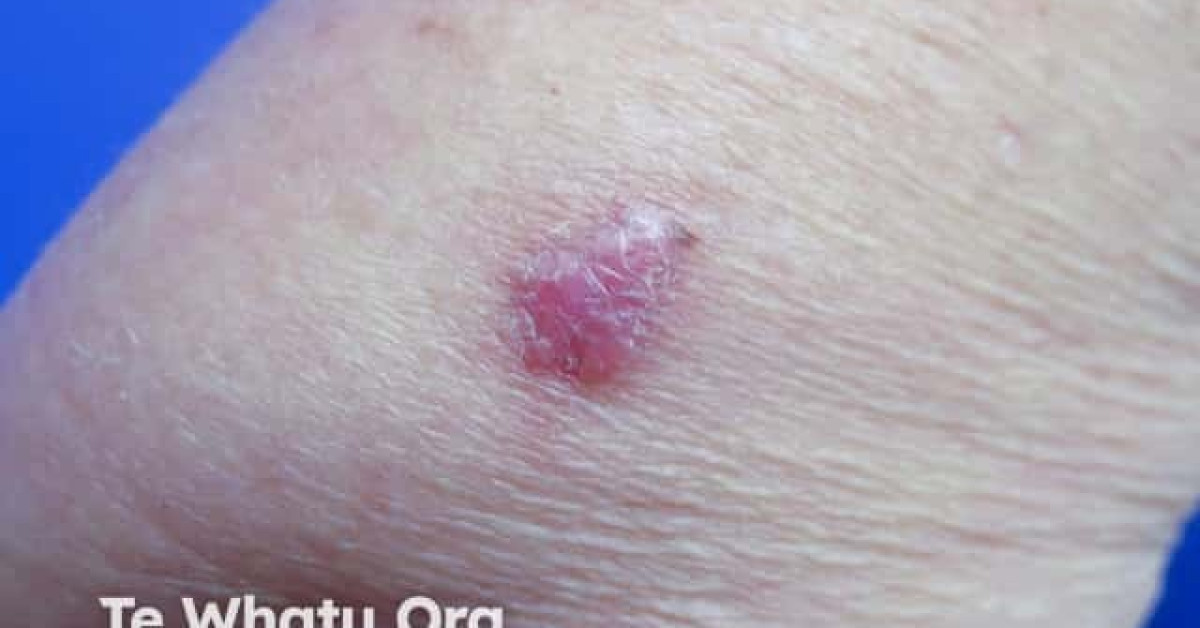 Nodular basal cell carcinoma, arm image