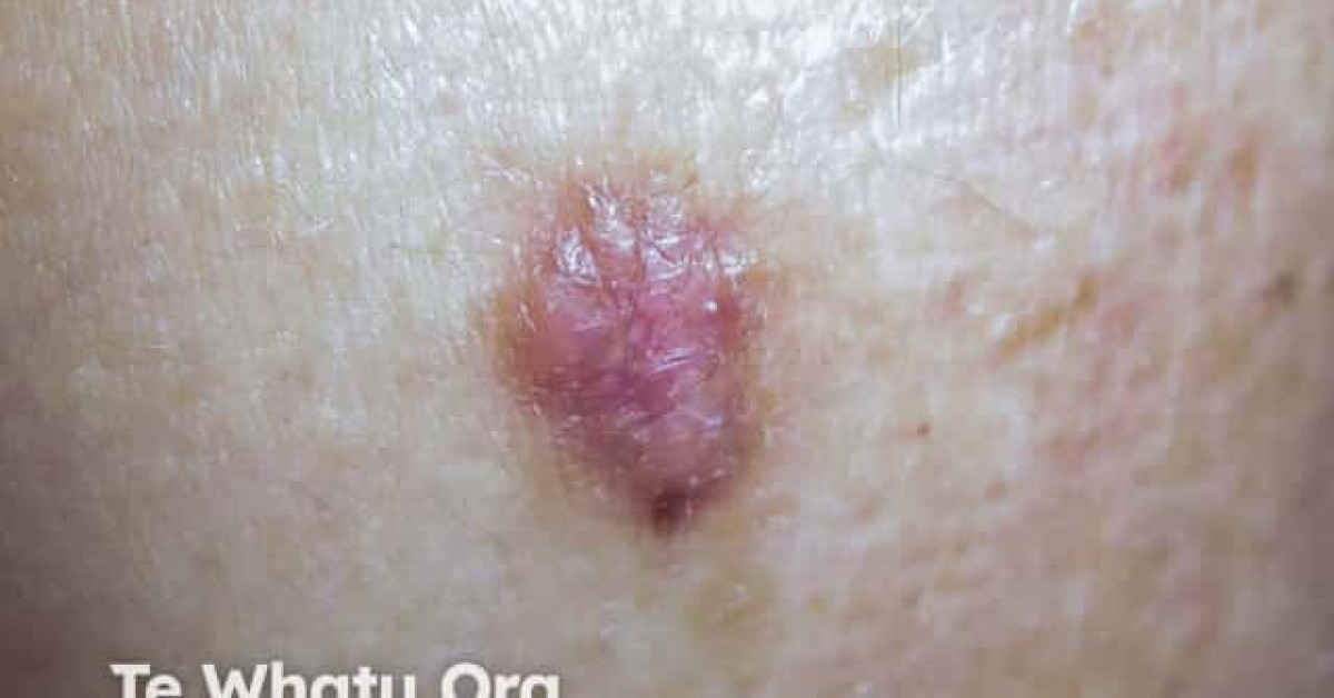 Nodular basal cell carcinoma, arm image