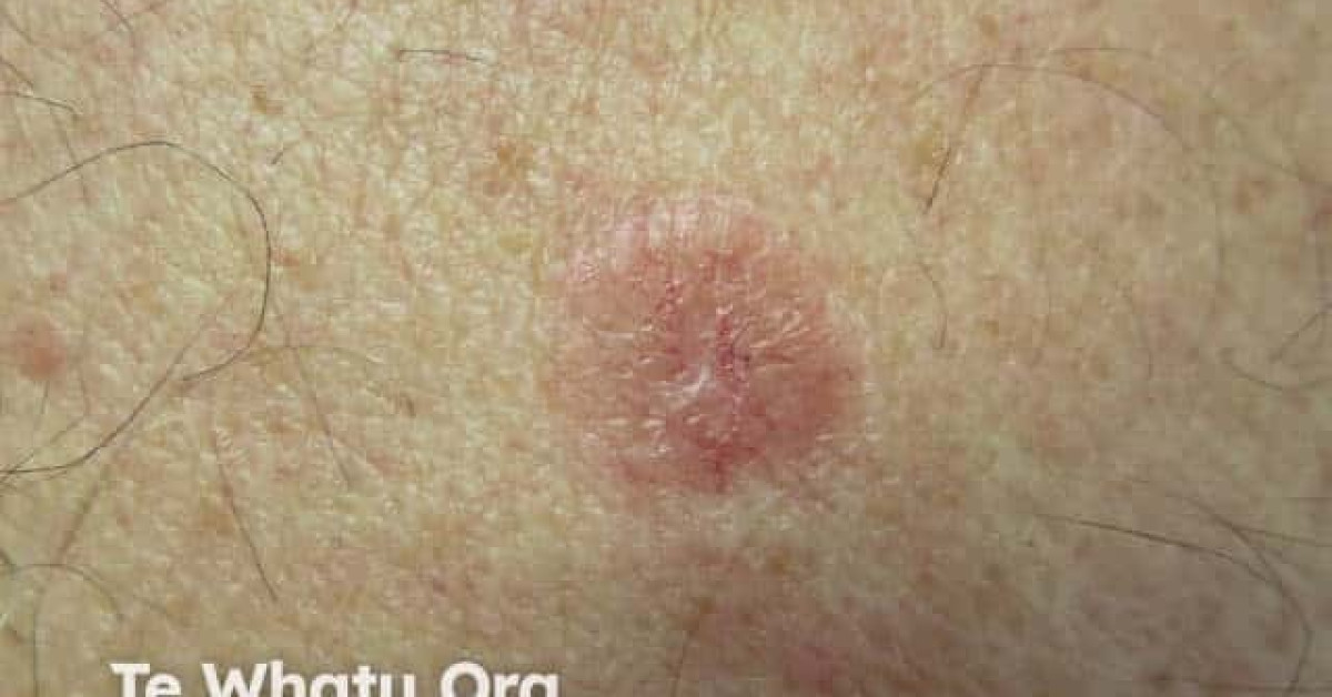 Nodular basal cell carcinoma, arm image