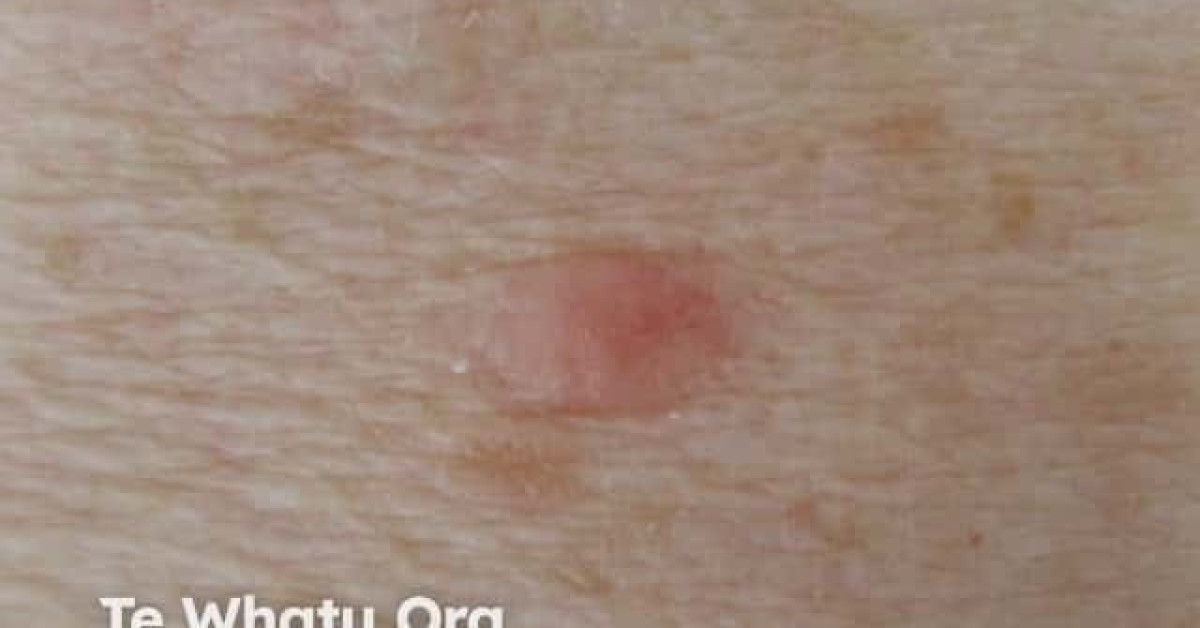 Nodular basal cell carcinoma, arm image