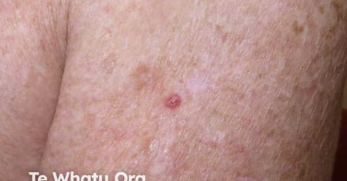 Nodular basal cell carcinoma, arm image