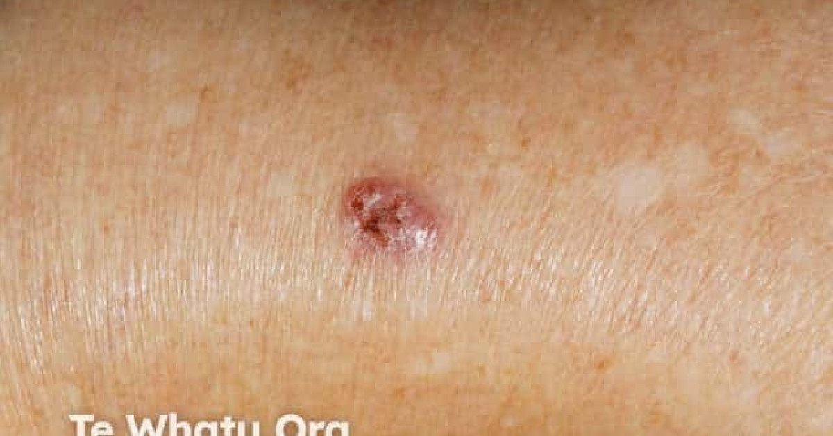 Nodular basal cell carcinoma, arm image