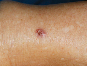 Nodular basal cell carcinoma, arm