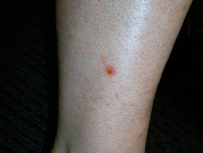 basal cell carcinoma early stages leg