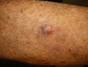 Nodular basal cell carcinoma, leg