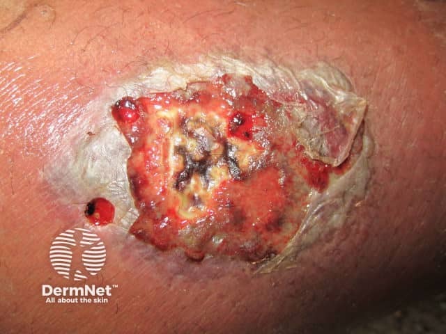 A necrotising streptococcal infection after subcutaneous injection of a recreational drug