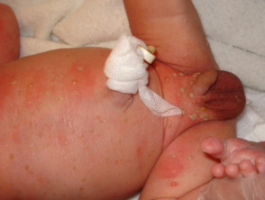 Neonatal pustular melanosis