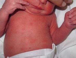 Neonatal pustular melanosis