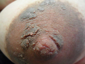 Male on nipple white bump Causes Of