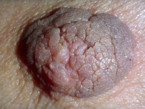Hyperkeratosis of the nipple and areola
