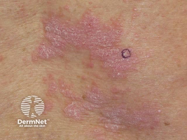 Nivolumab-induced lichenoid dermatitis
