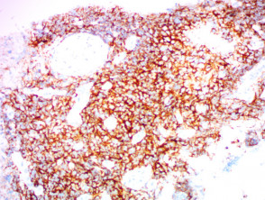 Natural killer T-cell lymphoma nasal type stained with CD56  x200