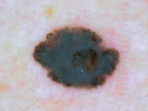 Dermoscopy of nodular melanoma Breslow 0.8 mm