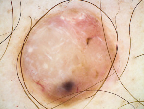 Nodular amelanotic melanoma dermoscopy