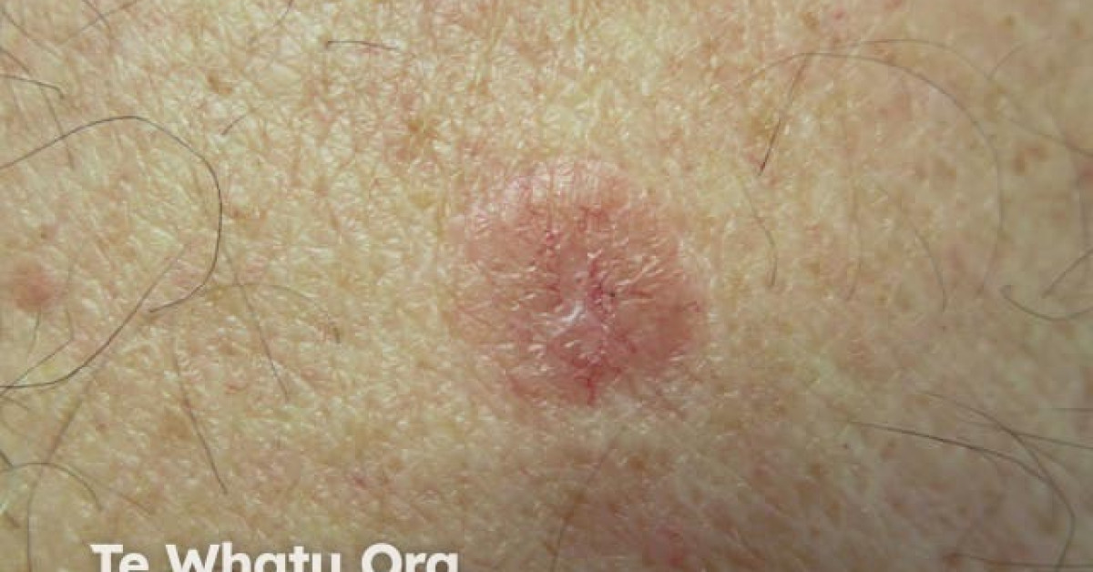 Nodular Basal Cell Carcinoma Image