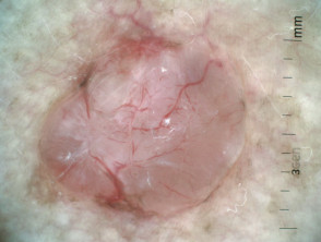 Nodular basal cell carcinoma 3 dermoscopic