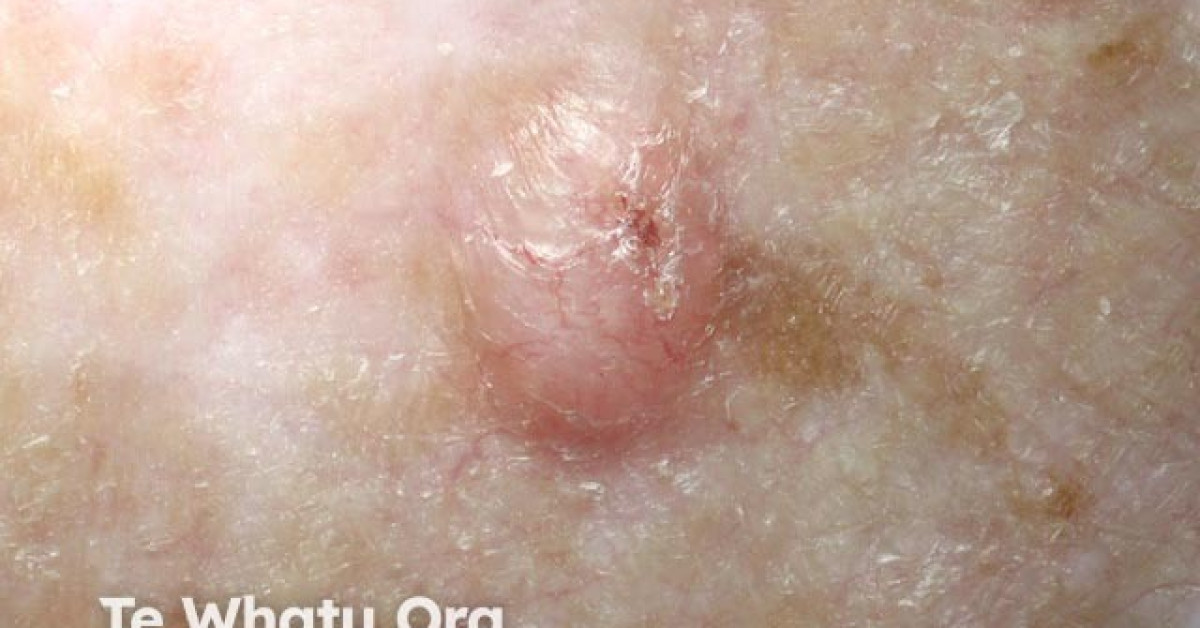 Nodular basal cell carcinoma 6 macro image