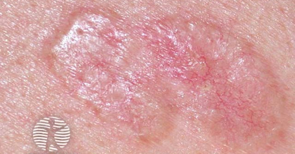 Nodular basal cell carcinoma image