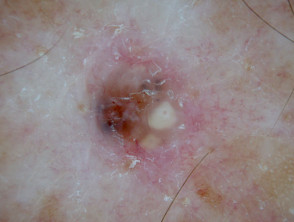 Nodular basal cell carcinoma dermoscopy