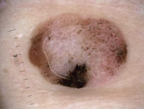 Nodular melanoma, Breslow 2.5 mm, polarised dermoscopy view