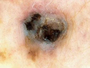 Dermoscopy of nodular melanoma