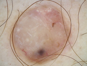 Nodular melanoma, Breslow 7.2 mm, polarised dermoscopy view