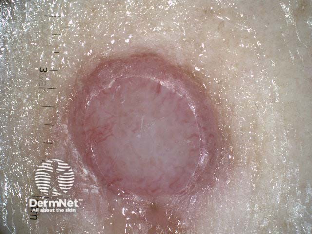 Nodular melanoma, Breslow 3.4 mm, nonpolarised dermoscopy view