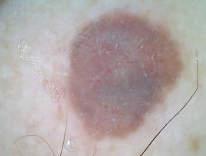 Dermoscopy of nodular melanoma Breslow 4 mm
