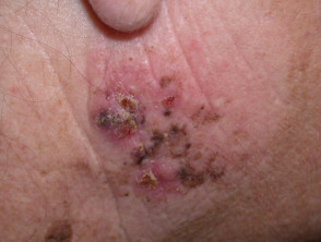 Nodular melanoma 7.5 mm arising in lentigo maligna meldanoma