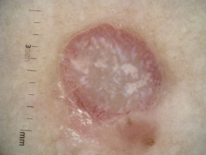 Nodular melanoma dermoscopy