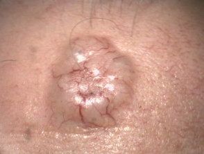 Nodulocystic basal cell carcinoma