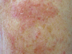 Nummular dermatitis in a patient on anti-TNF