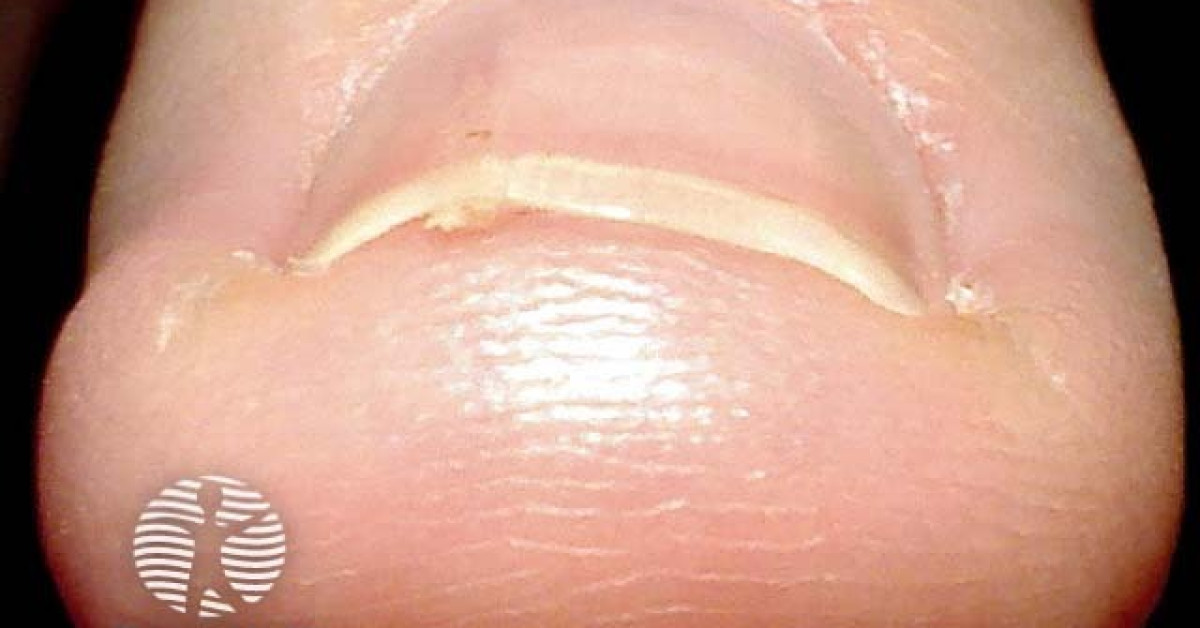 Subungual hyperkeratosis due to onychopapilloma image