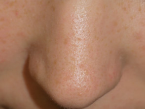 enlarged pores cheeks