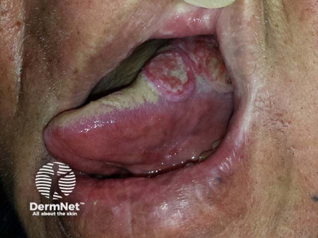 Carcinoma of the tongue