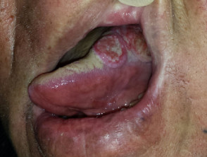 Carcinoma of the tongue