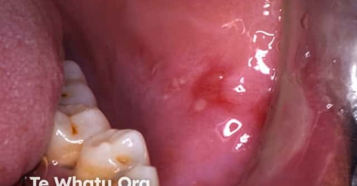 Oral pemphigus vulgaris image