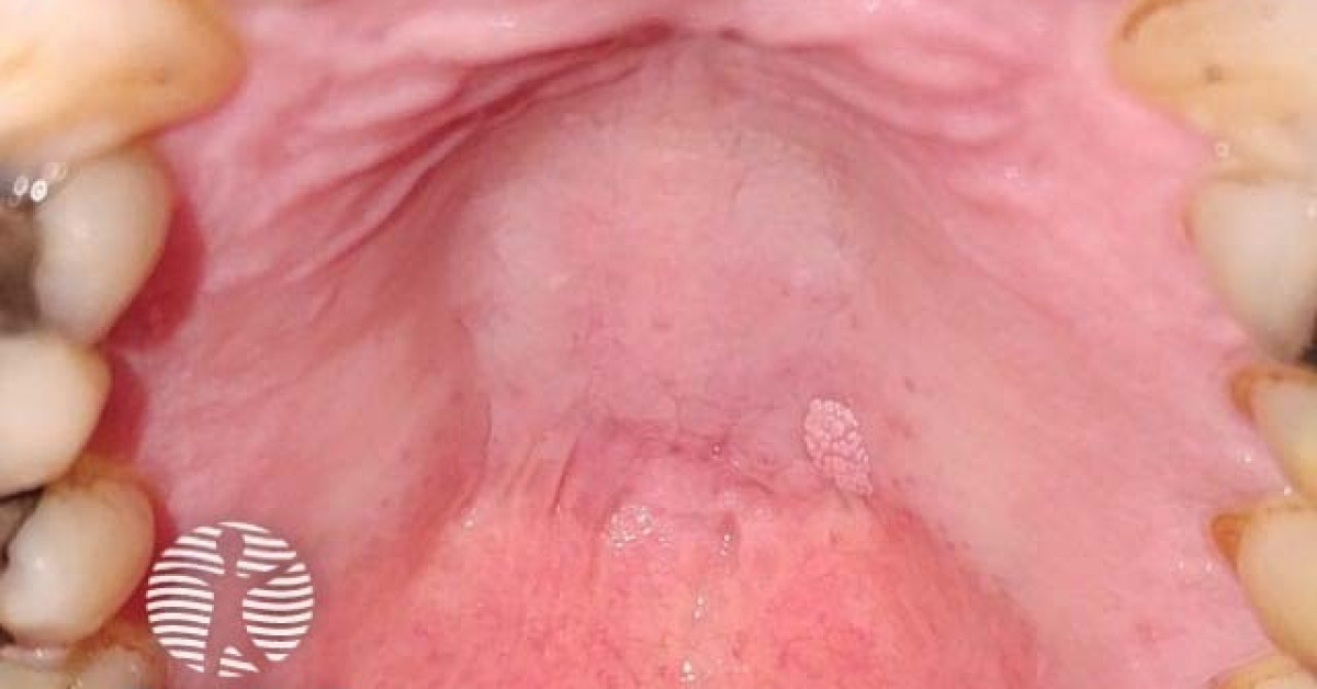icd 10 code for oral squamous papilloma
