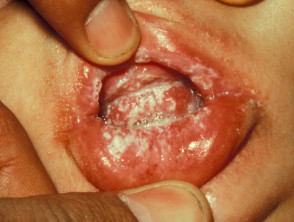 Oral thrush in a baby