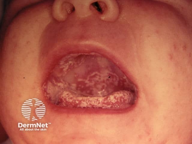 Oral thrush in a baby