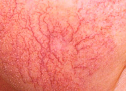 On spots little foreskin red 🏷️ Why I