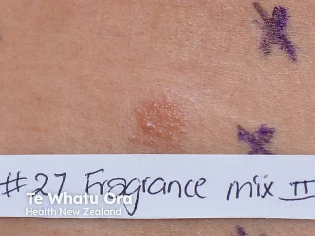 Positive patch test to fragrance - fragrance mix II