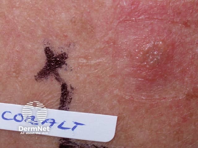 Positive patch test to cobalt